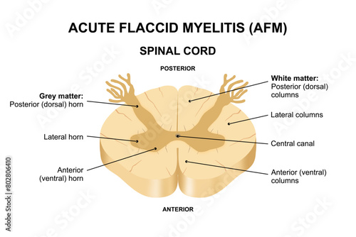 Acute Flaccid Myelitis (AFM)