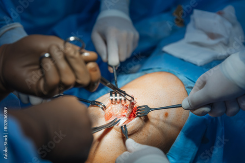 Canvas Print close-up of a severed human knee on an operating table where knee replacement su