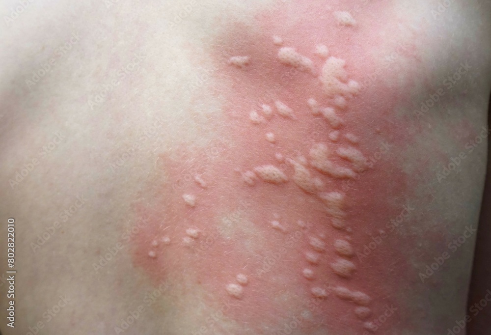 Fototapeta premium Rash in a child caused by nettles