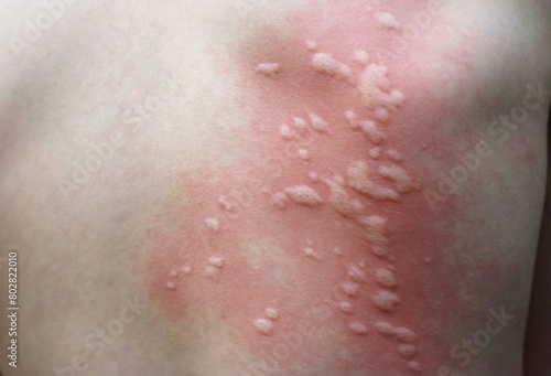 Rash in a child caused by nettles