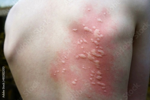 Rash in a child caused by nettles