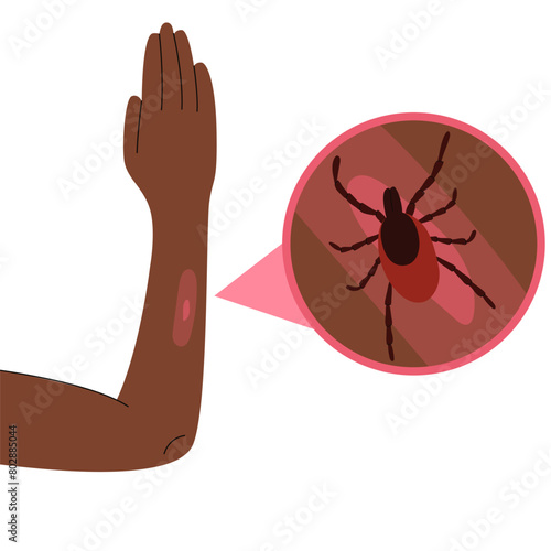 The  dark skin  human hand with the tick bite. Tick bite hand.Tick bite. Healthcare illustration.