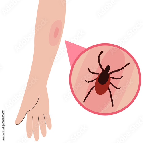The human hand with the tick bite. Tick bite hand.Tick bite. Healthcare illustration.
