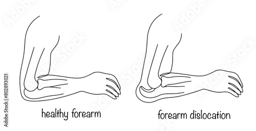 Forearm dislocation