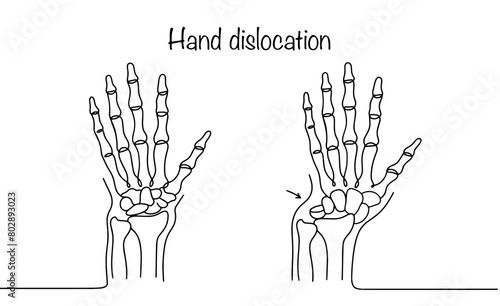 Hand dislocation