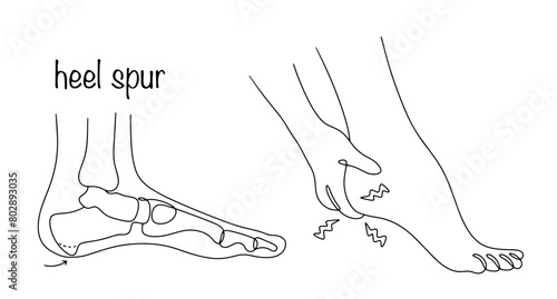 Heel spur