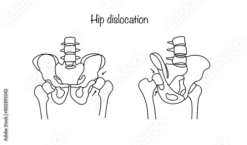 Hip dislocation