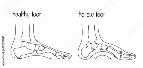 Hollow foot