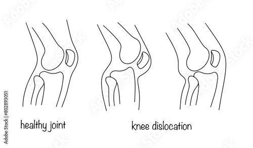 Knee dislocation