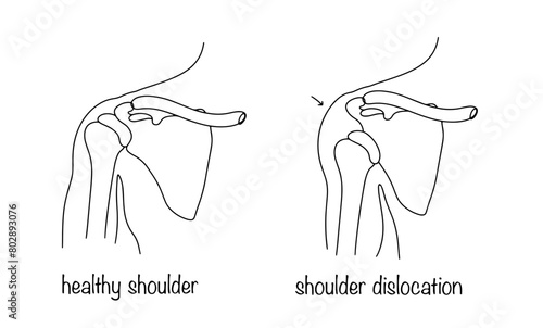 Shoulder dislocation