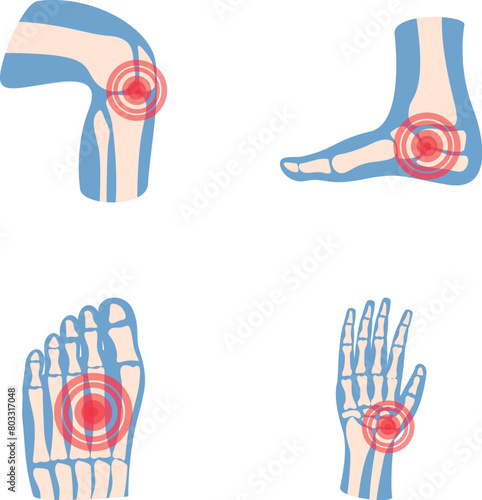 Arthritis icons set cartoon vector. Human joint with pain ring. Rheumatology, medicine