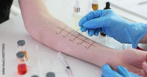 Skin prick test for allergies on a patient hand in clinic photo