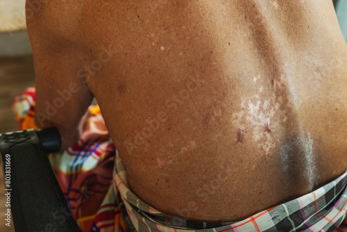 An old Asian man had a skin disease on his back, ringworm, fungus, and after healing, he had a prominent scar on his back.
