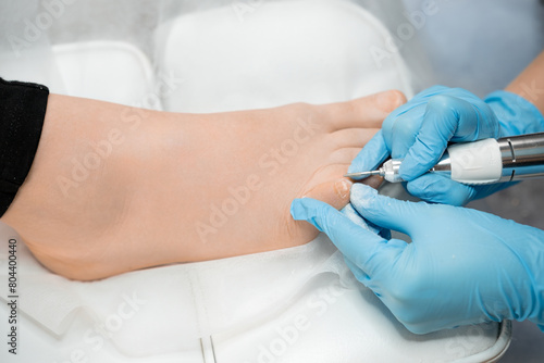 A medical pedicure session involves a podiatrist treating the toenail using a milling machine.