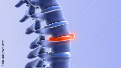 Human spine with bulging disc
