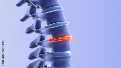 Human spine with degenerative disc
