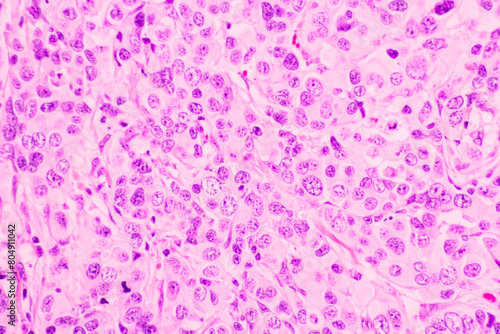 Backgrounds of human cells tissue of lung human under the microscope in pathology lab.View in microscopic of ductal cell carcinoma  adenonocarcinoma from human breast cancer  tissue section by H and E