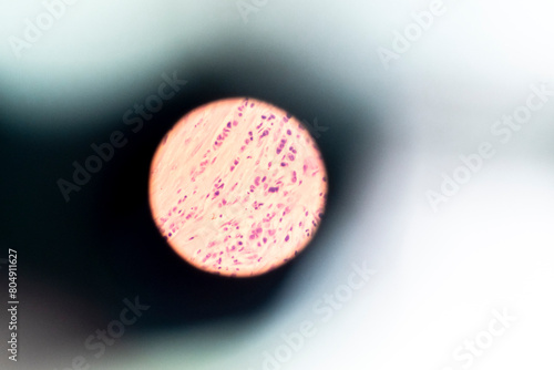 Selective focus human cells tissue in eyepiece of microscope in laboratory.Examining histological sample, a biopsy in the laboratory of cancer research.Medical patholology and cytology laboratory.