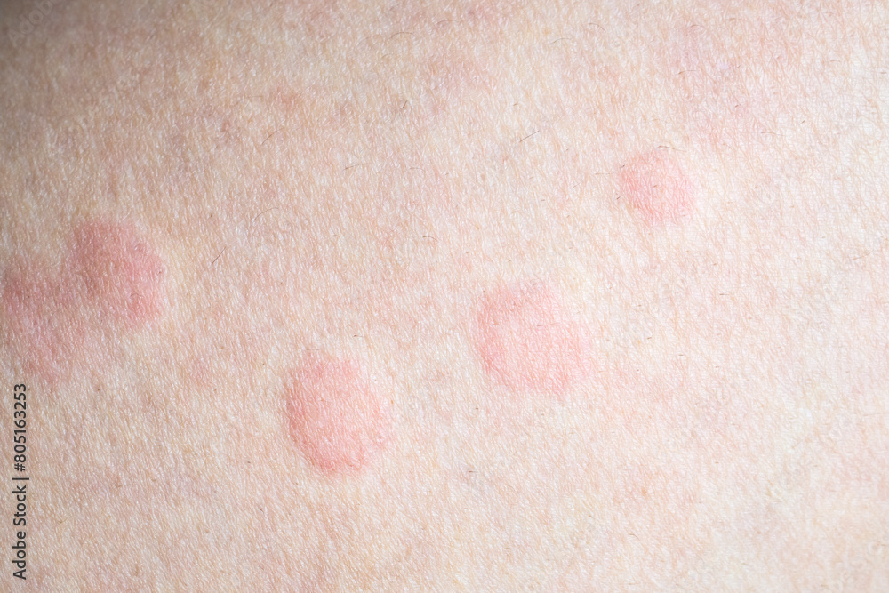 Fototapeta premium Skin allergy rash dermatitis texture close up