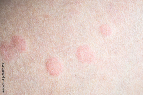 Skin allergy rash dermatitis texture close up photo
