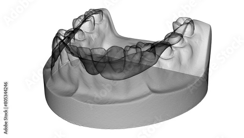 3D rendering - x-ray view of a cast dental photo