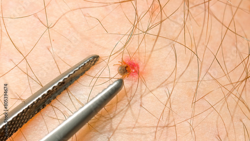 Professional dermatologist using specialized tweezers to remove embedded tick from patient's skin. Healthcare and medical procedures.