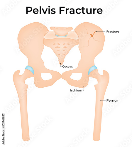 Pelvis Fracture Science Design Vector Illustration Diagram