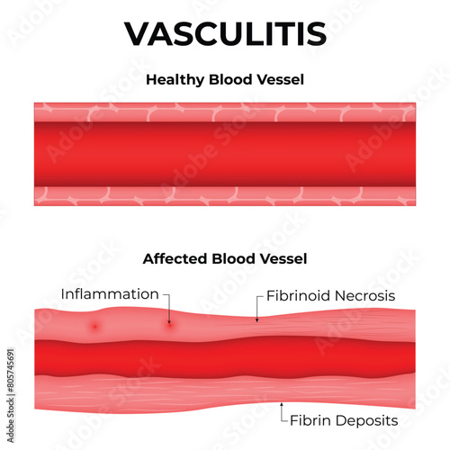 Vasculitis Science Design Vector Illustration Diagram