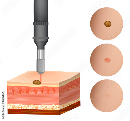 Birthmark laser Removal. Treatment Nevus. Before and after procedure. Removing mole by medical laser