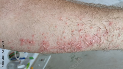 Foto Poison Ivy rash and infection on Forearm
