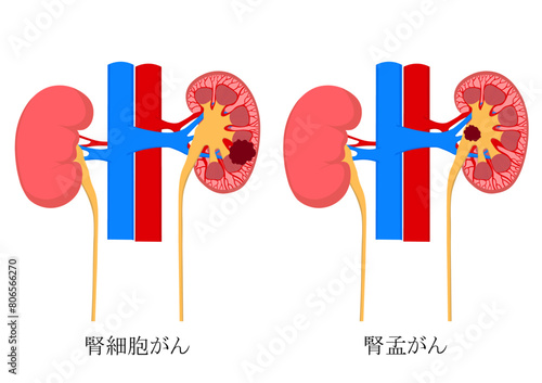 腎細胞がんと腎孟がんの腎臓