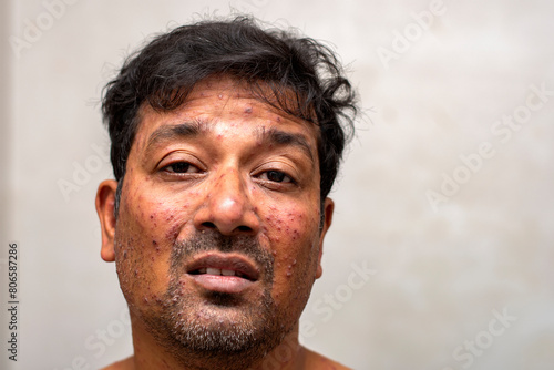 Obraz na plátně closeup face of a man who having varicella blister or chickenpoxor Monkeypox new disease dangerous over the world