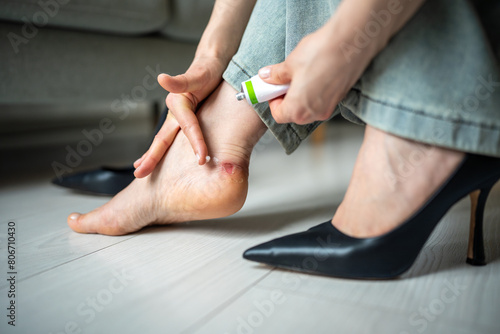 Closeup of woman nursing blistered heel with healing balm. Traumatised skin, callus from uncomfortable shoes with heels. Treatment of chafed foot. Discomfort, recovery, soreness, sensitivity, skincare photo