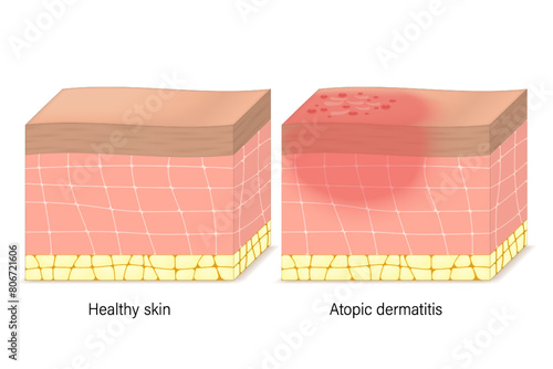 Atopic dermatitis symptoms vector. Cross-section of human skin with eczema. Comparison between healthy skin and atopic dermatitis.