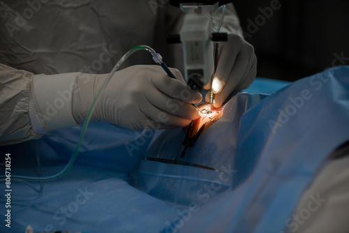 A close-up of the work of an ophthalmologist, behind the laser eye microsurgery apparatus. A doctor using a microsurgical instrument performs an operation on the patients eyes