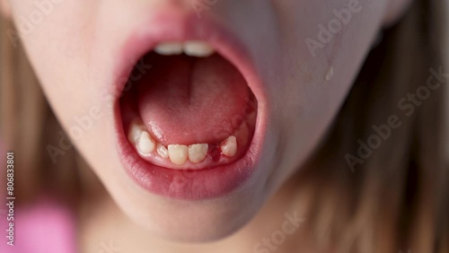 Portrait of a girl crying after pulling out her baby teeth, close-up. photo