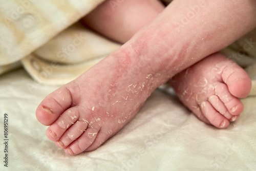 dry skin on baby neworn feet
