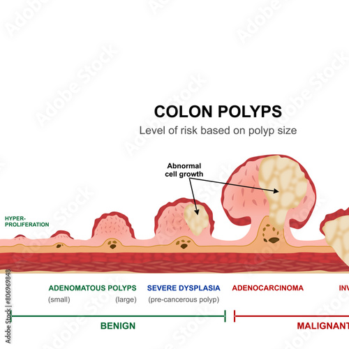 Colon Polyps Cancer Stages Illustration