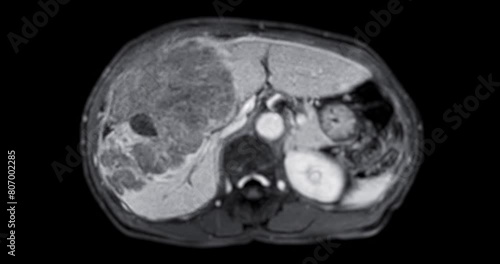 CT Abdomen show a retroperitoneal mass with a peripheral fatty component with thin septa and poorly defined solid-appearing areas with no clear demarcation between them and fat. photo