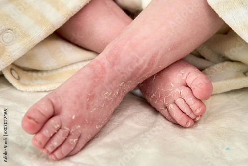 Newborn baby feet with flaky dry skin. Infant after born with very dry, wrinkled, cracked skin on foot. Close up