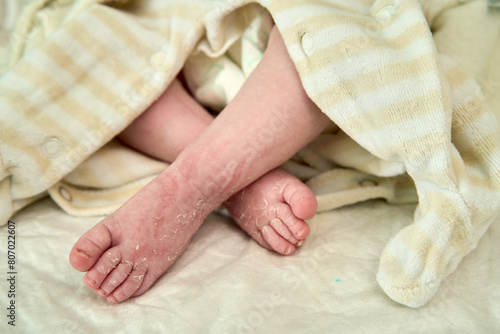 Palmoplantar psoriasis, allergic contact dermatits and atopic dermatitis in infants.