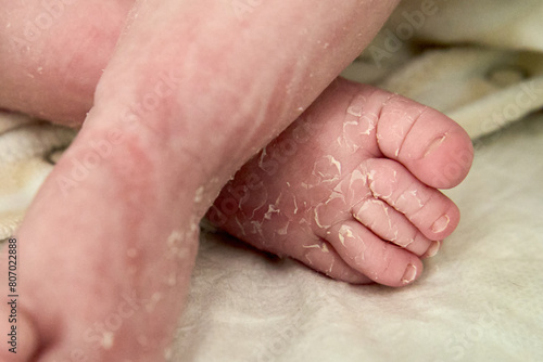 Closeup newborn baby feet with peeling skin