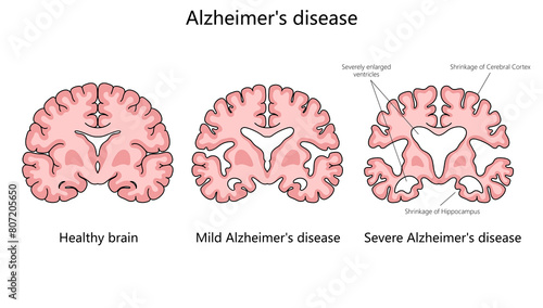 Fotografie progression of Alzheimer disease, comparing a healthy brain to those with mild and severe Alzheimer structure diagram hand drawn schematic raster illustration