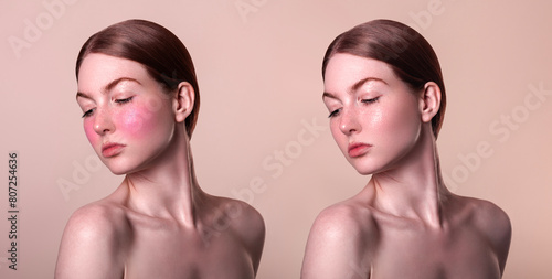Rosacea couperose redness skin treatment, before and after result of IPL laser treatment, red spots on cheeks, red-haired woman with sensitive skin, patient face close-up on beige background
