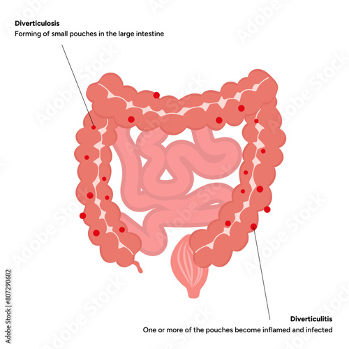 Ulcerative colitis