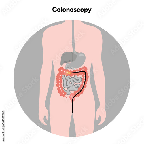 Colonoscopy diagram gastroscopy with endoscope 