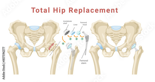 Total hip replacement surgery with anatomical acetabular prosthesis medical poster isometric vector photo