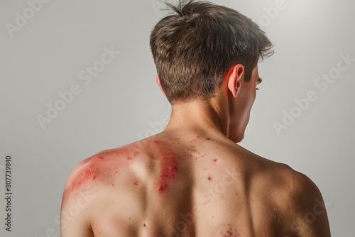Male Back with Painful Rash, Red Spots Blisters on the Skin. Human Body with Health Problem. Monkeypox, Monkey Pox Disease Symptoms. Close Up Patient. Banner, Copy Space. Dengue Fever Infection, MPOX. photo