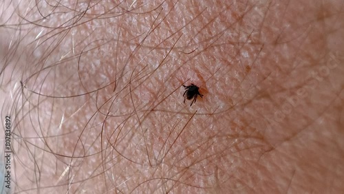tick sucking blood on human skin close-up