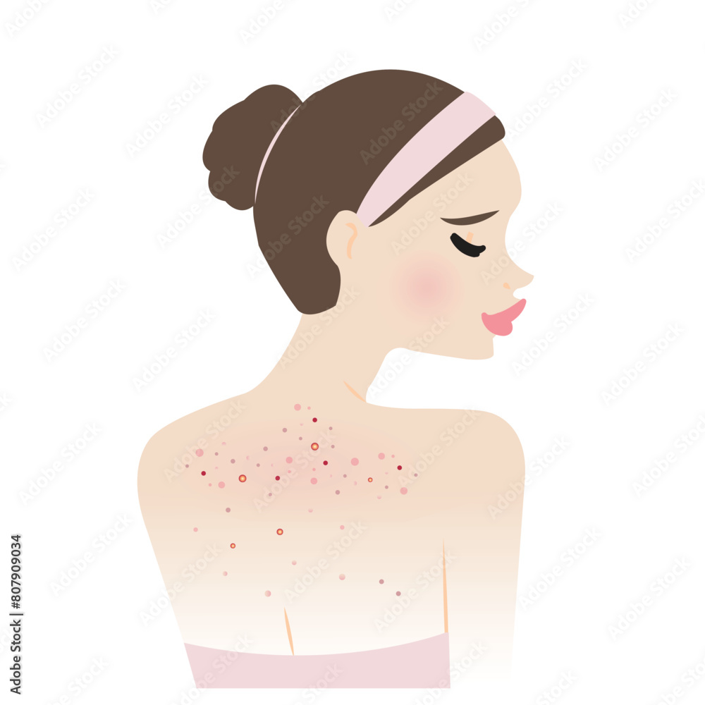 The woman with body acne vector illustration isolated on white background. Acne, pimples, blackheads, comedones, whiteheads, papule, pustule, nodule and cyst on back. Skin care and beauty concept. The woman with body acne vector illustration isolated on white background. Acne, pimples, blackheads, comedones, whiteheads, papule, pustule, nodule and cyst on back. Skin care and beauty concept.